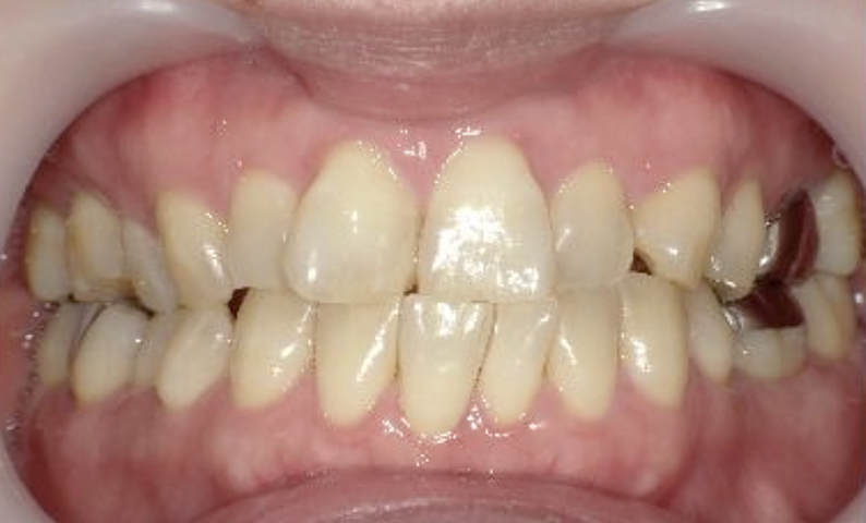 部分矯正 40代の症例写真