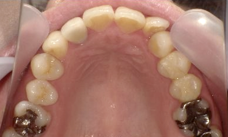 部分矯正 40代の症例写真