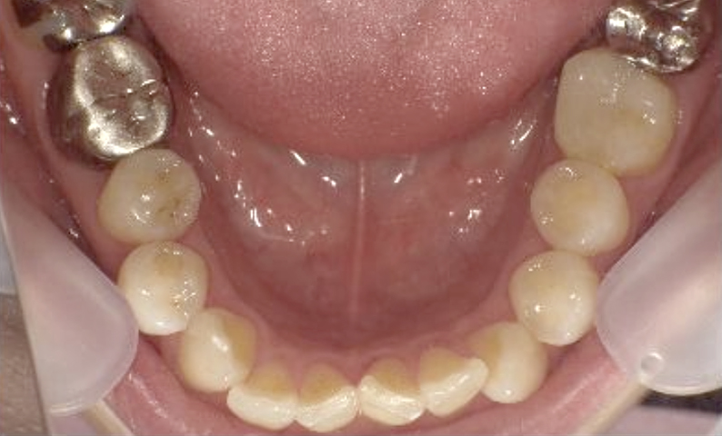 部分矯正 40代の症例写真