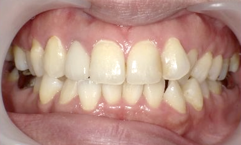 部分矯正 40代の症例写真