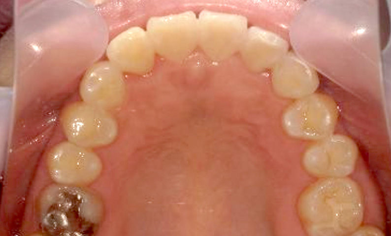 部分矯正 40代の症例写真