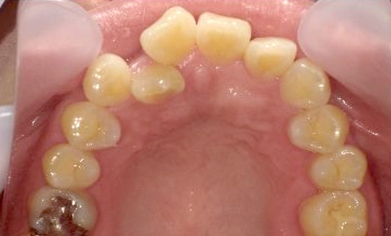 部分矯正 40代の症例写真