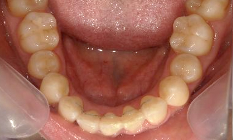 部分矯正 40代の症例写真