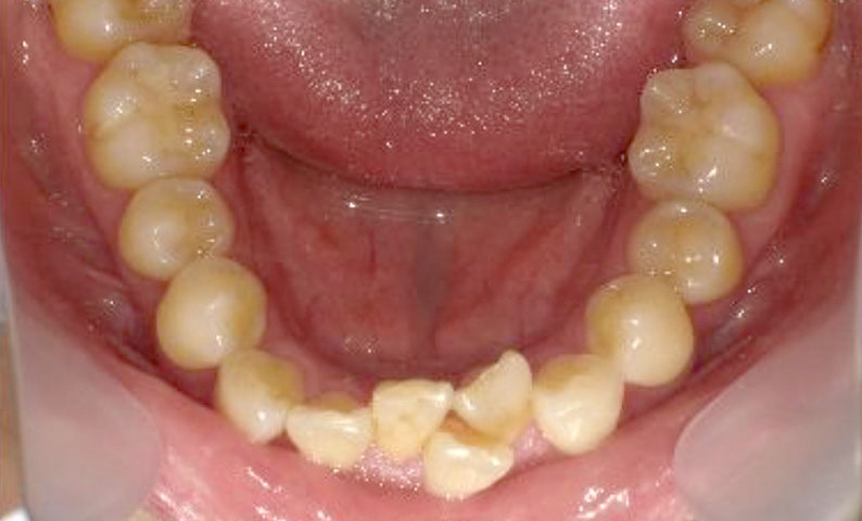 部分矯正 40代の症例写真