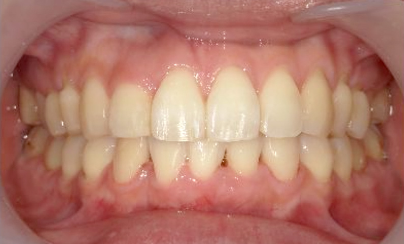 部分矯正 40代の症例写真