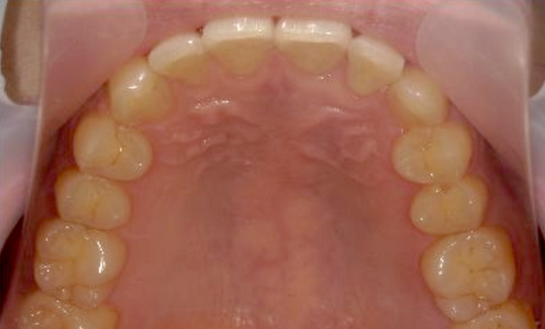 部分矯正 40代の症例写真