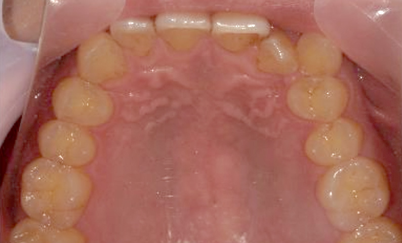 部分矯正 40代の症例写真