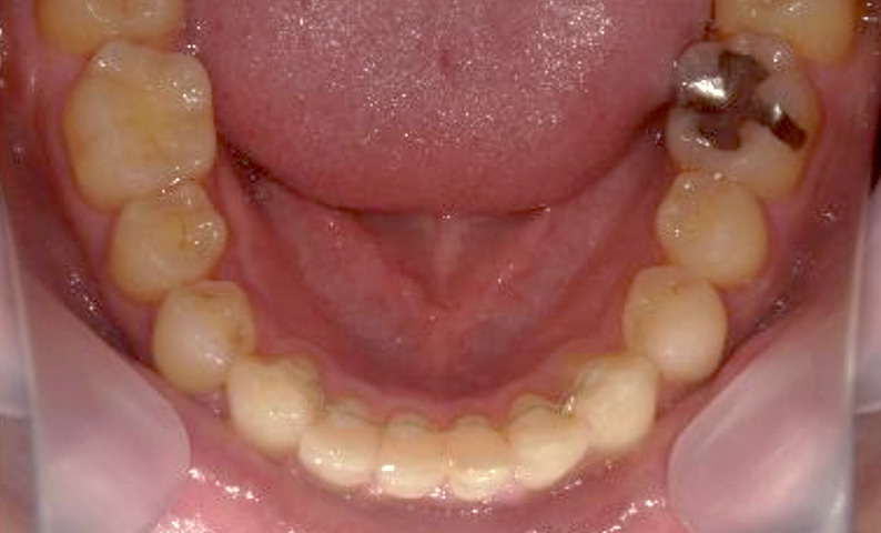 部分矯正 40代の症例写真