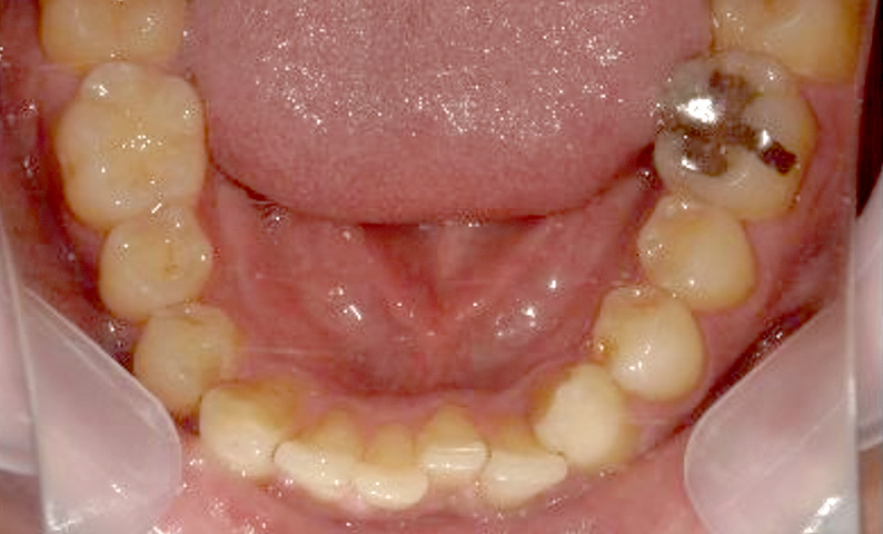 部分矯正 40代の症例写真