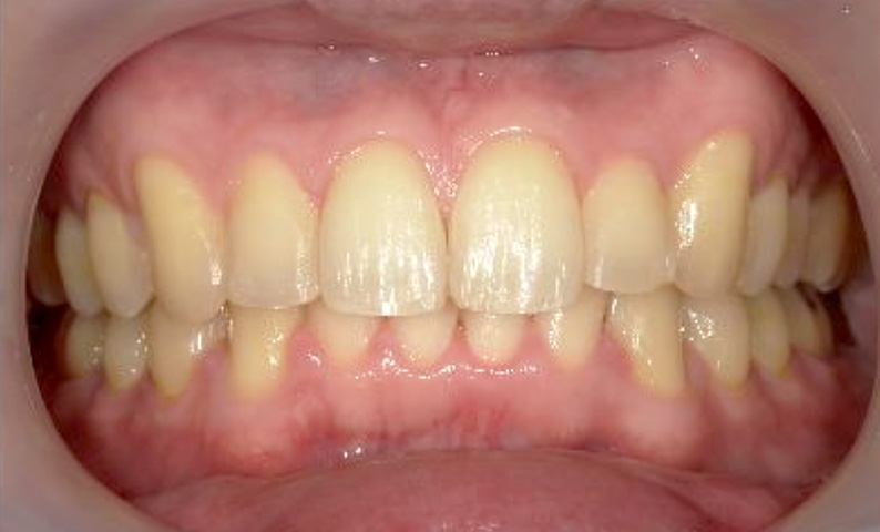 部分矯正 40代の症例写真