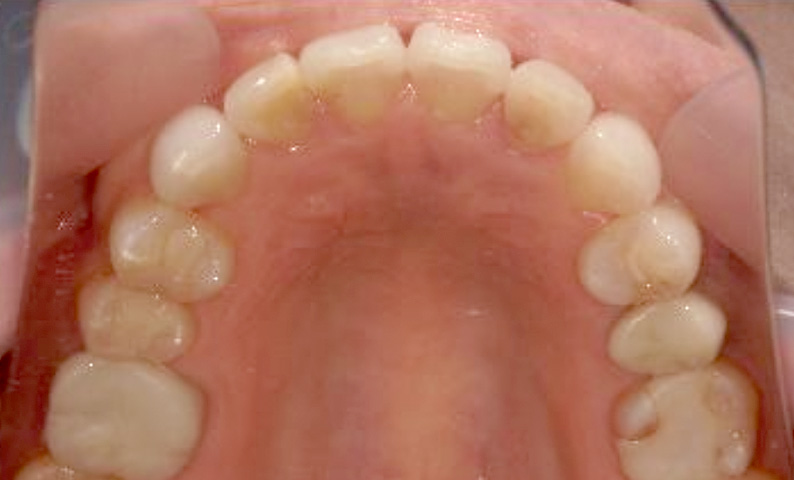 部分矯正 40代の症例写真