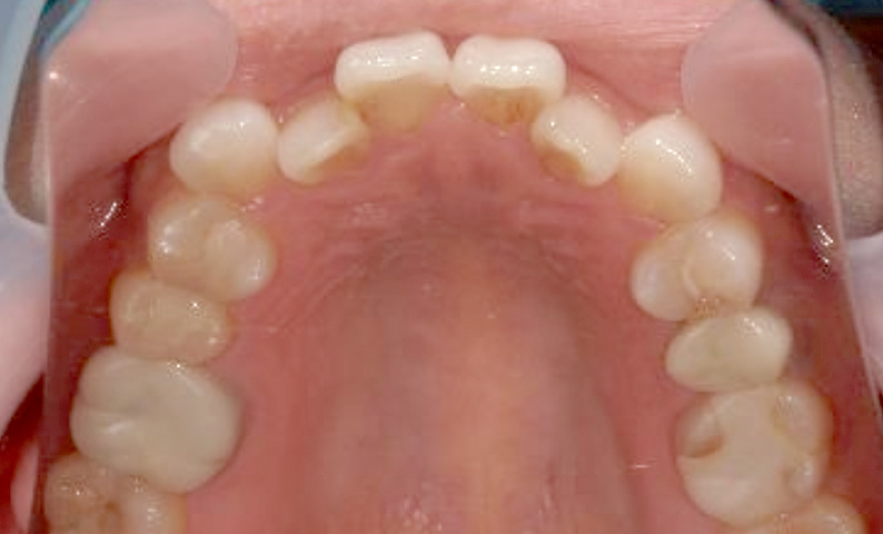 部分矯正 40代の症例写真