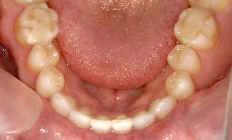 部分矯正 40代の症例写真