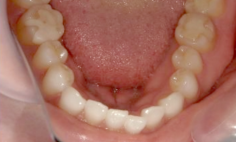 部分矯正 40代の症例写真