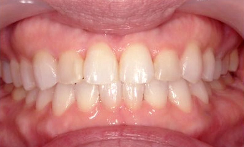 部分矯正 40代の症例写真