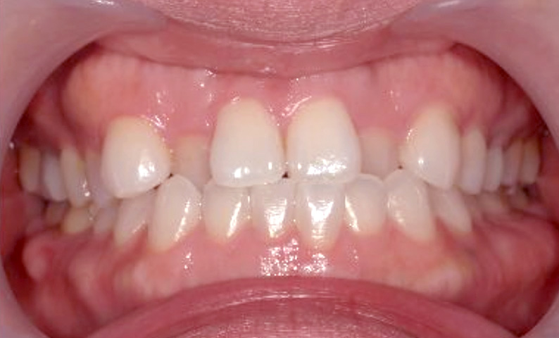 部分矯正 40代の症例写真