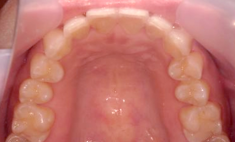 部分矯正 40代の症例写真