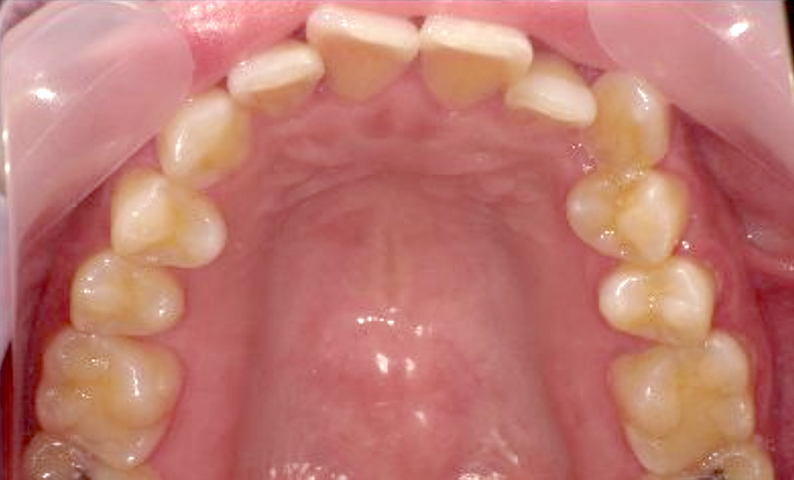 部分矯正 40代の症例写真