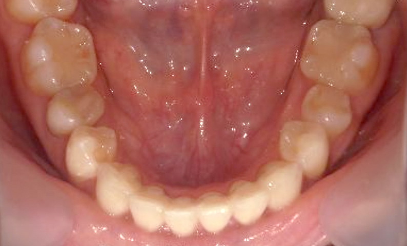 部分矯正 40代の症例写真