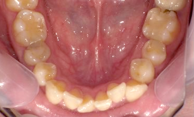 部分矯正 40代の症例写真