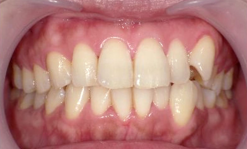 部分矯正 40代の症例写真