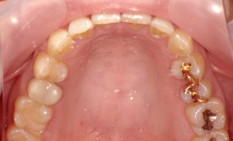 部分矯正 40代の症例写真