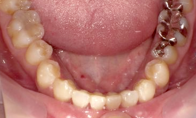 部分矯正 40代の症例写真