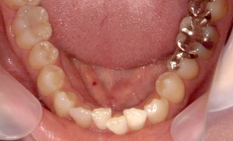 部分矯正 40代の症例写真