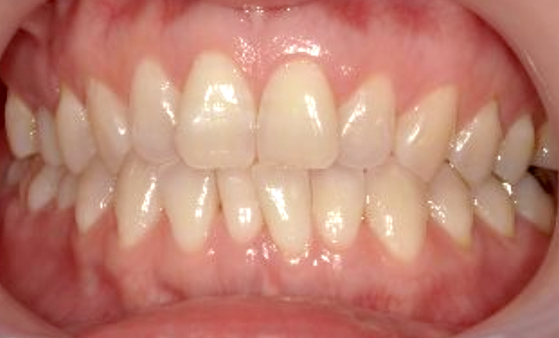 部分矯正 40代の症例写真