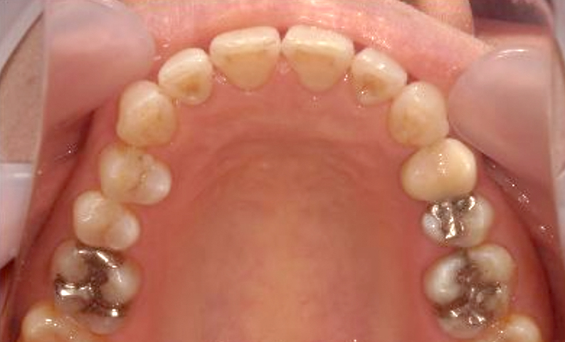 部分矯正 40代の症例写真