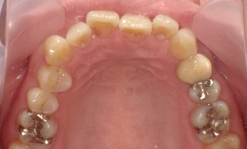 部分矯正 40代の症例写真