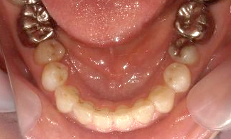 部分矯正 40代の症例写真