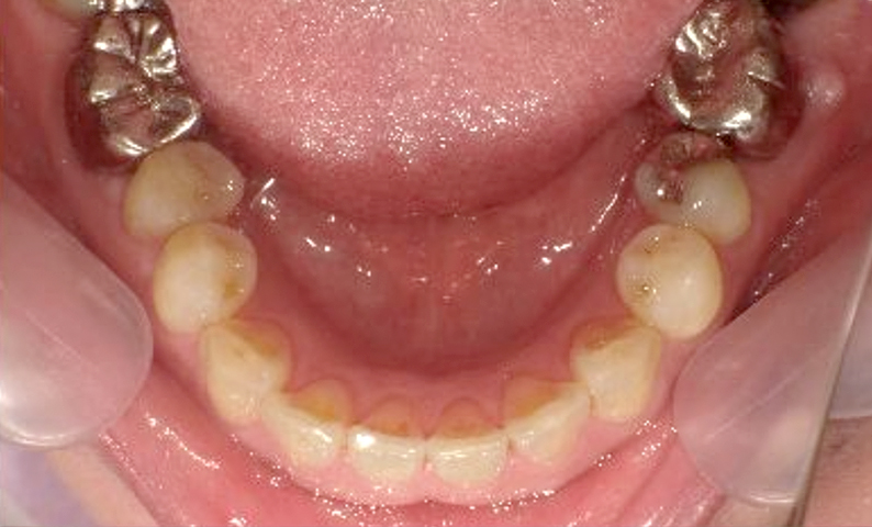 部分矯正 40代の症例写真