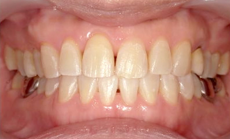 部分矯正 40代の症例写真