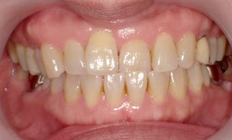 部分矯正 40代の症例写真