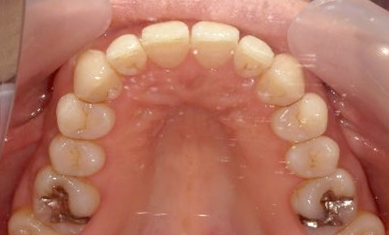 部分矯正 40代の症例写真