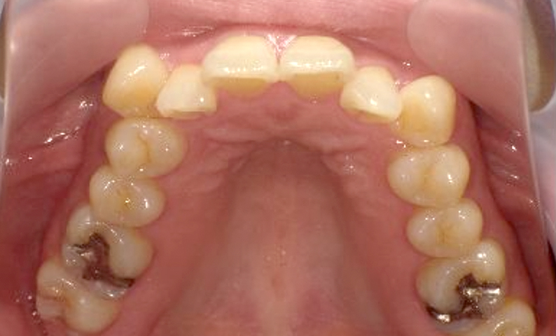 部分矯正 40代の症例写真
