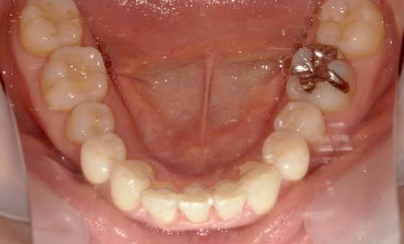 部分矯正 40代の症例写真