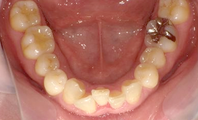 部分矯正 40代の症例写真