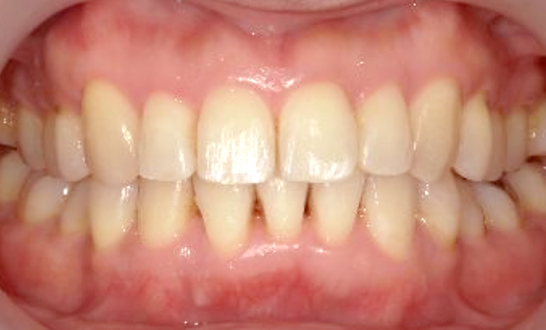 部分矯正 40代の症例写真