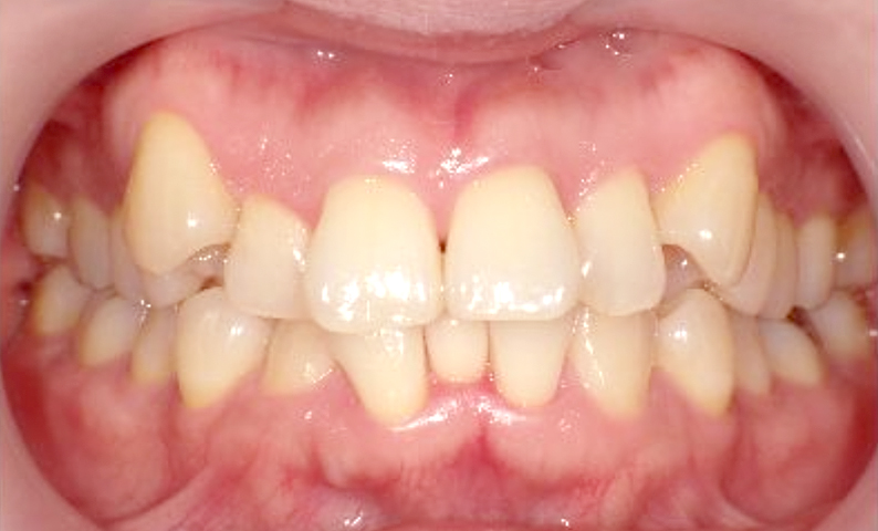 部分矯正 40代の症例写真