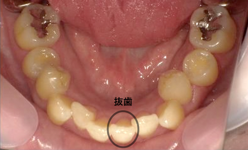 部分矯正 40代の症例写真
