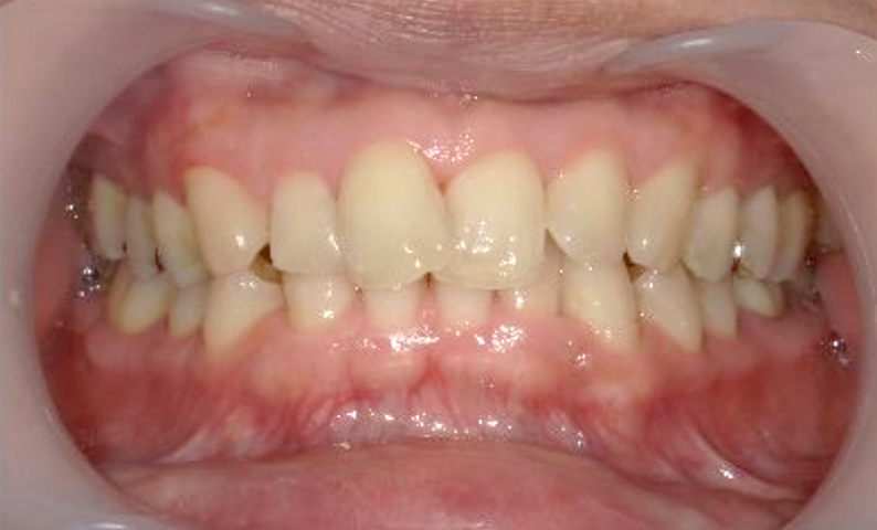 部分矯正 40代の症例写真