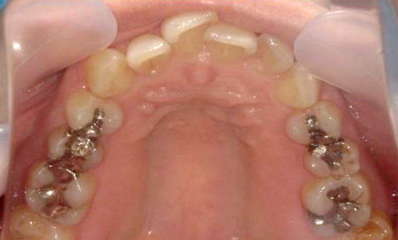 部分矯正 40代の症例写真