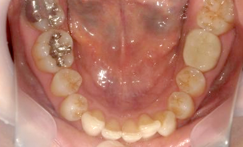 部分矯正 40代の症例写真