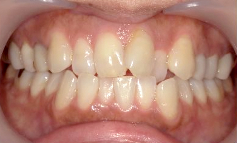 部分矯正の症例 前歯のガタガタ