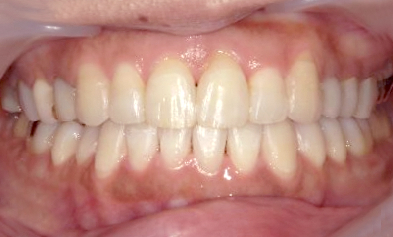 部分矯正の症例 前歯のガタガタ