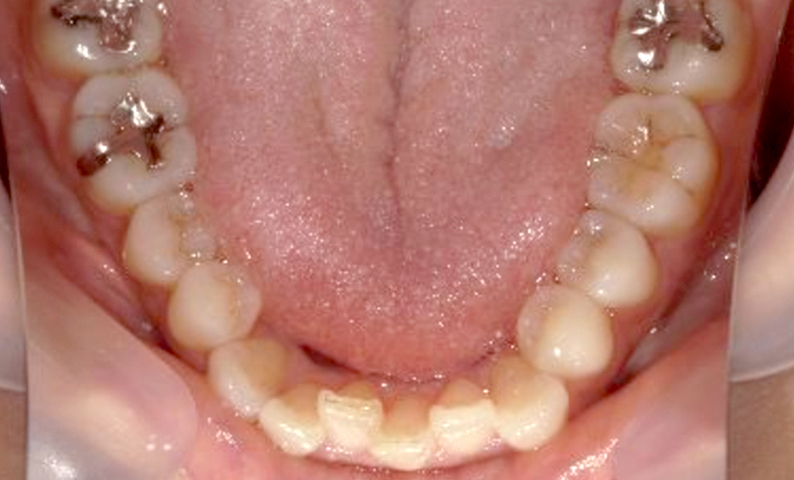 部分矯正 40代の症例写真