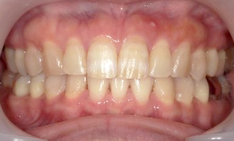 部分矯正 40代の症例写真