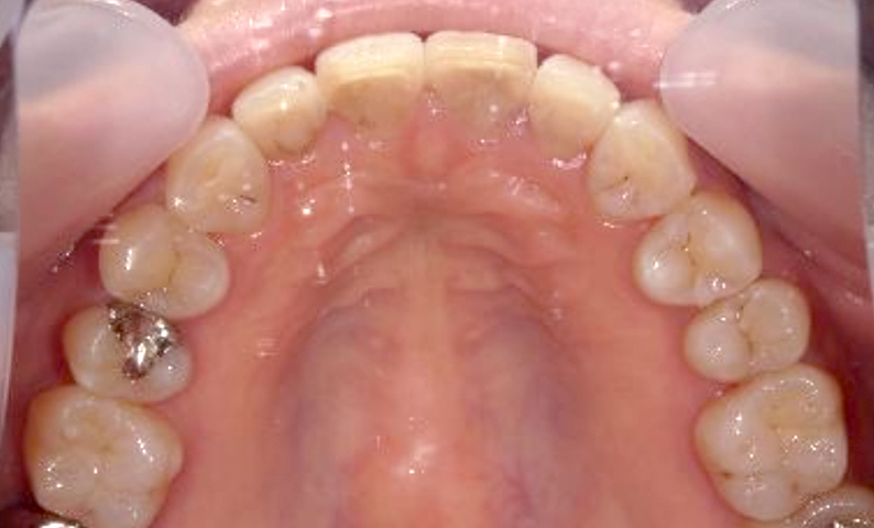 部分矯正 40代の症例写真